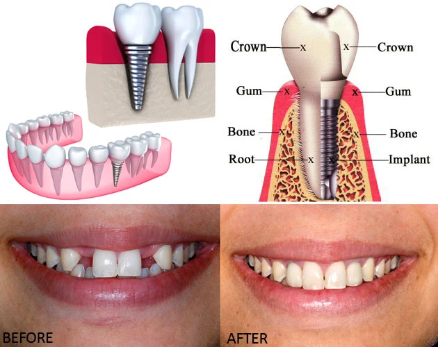 Dental Implants