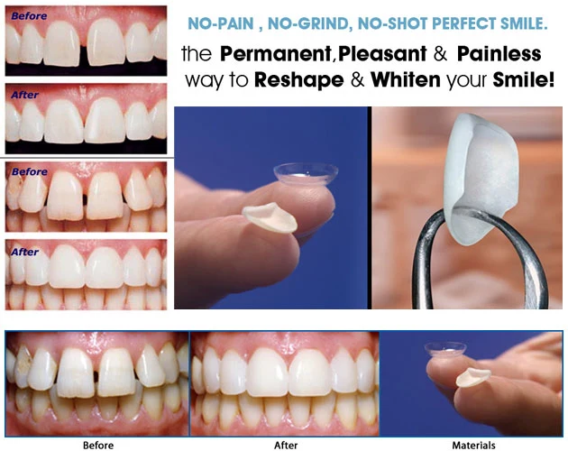 Lumineers Veneers
