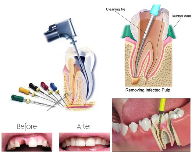 Root Canal Treatment